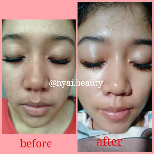 THERASKIN PAKET ACNE GLOw FAILA PUTRI