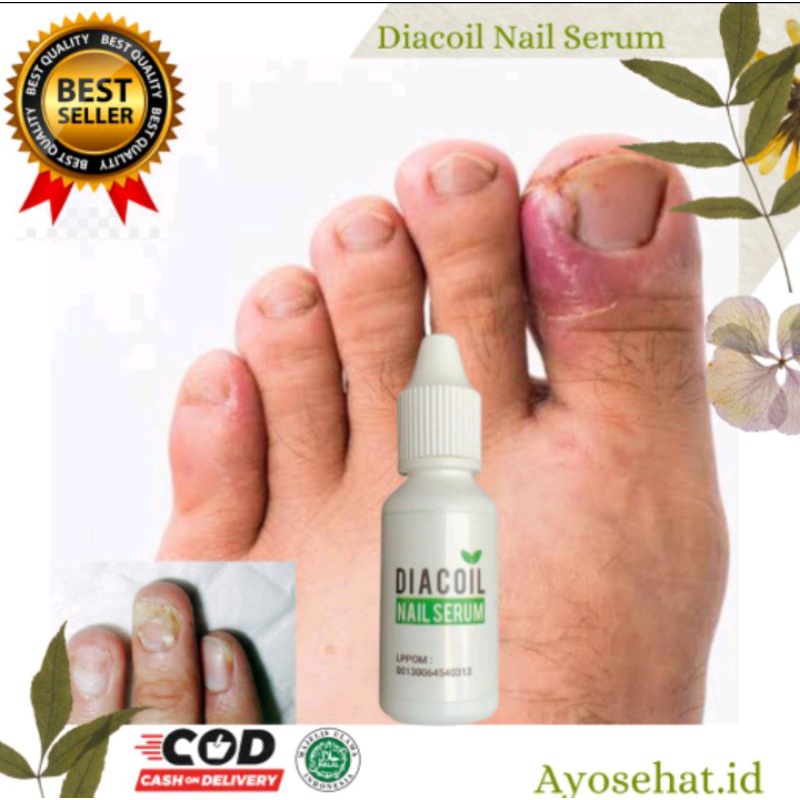 [COD] ~ DIACOIL NAIL SERUM ORIGINAL OBAT  JAMUR KUKU CANTENGAN DAN