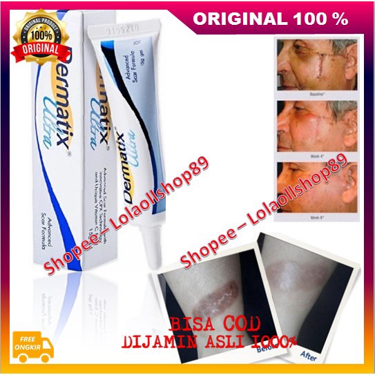 Dermatix Ultra Gel Penghilang Bekas Luka / Keloid ANTI SCAR Stretchmark Perbaikan Kulit Terbukti Amp