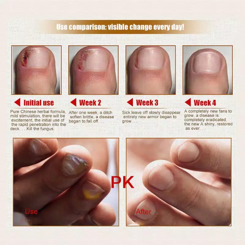 [✅COD] WATER ICE LEVIN BRAND Herbal Nail Repair Treatment Essential Oil Serum Kuku