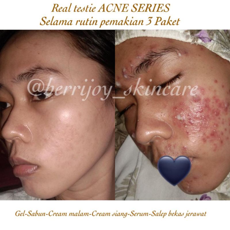 Gel Anti Acne