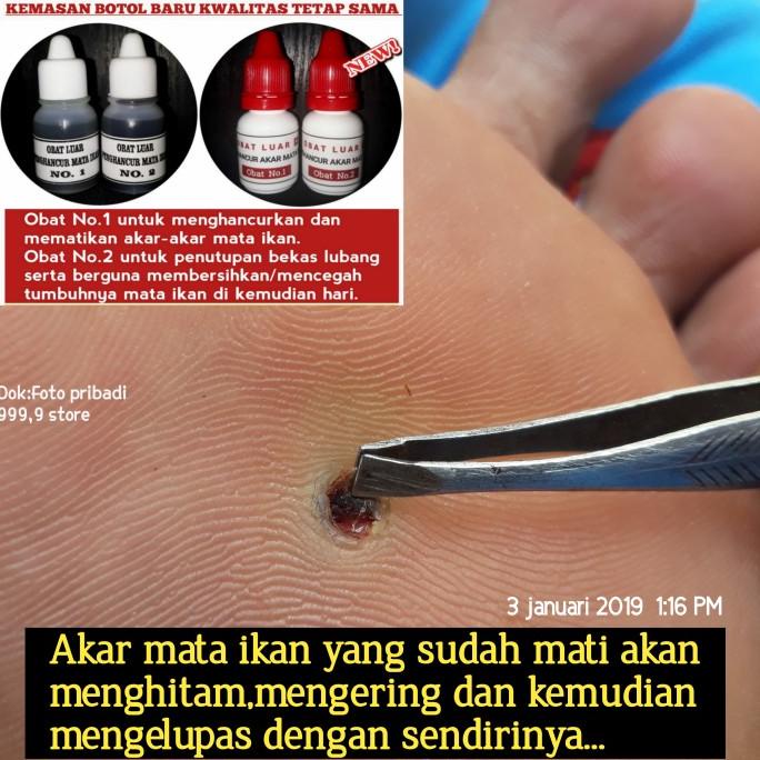 TERLARIS Obat penyakit mata ikan atau clavus bukan plester salep callusol Murah