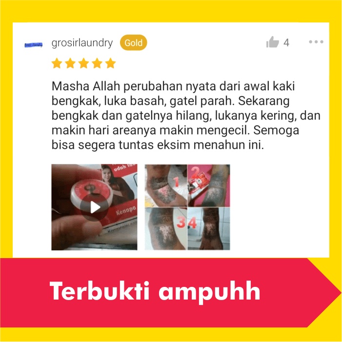 Salep Obat Gatal Eksim Kering Basah Menahun Paling Ampuh Kurap Panu Selangkangan Jamur Gatel Kulit-2