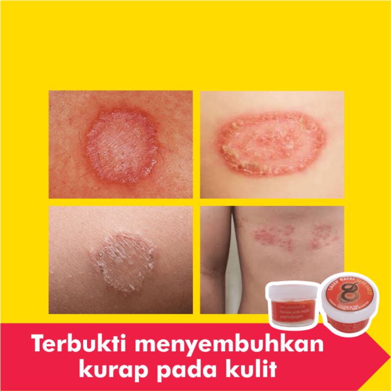 Salep Obat Kurap Kudis Paling Ampuh Gatal Kulit Gatel Kadas Eksim Kering Kutu Air Jamur Selangkangan-4