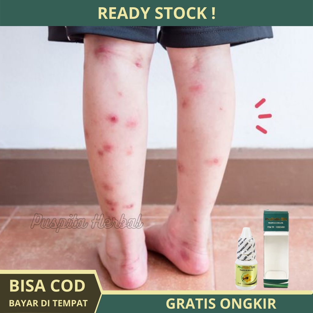 Obat Koreng Bernanah - Gatal Koreng Bernanah, Koreng Bernanah Di Kaki, Obat Oles Koreng Bernanah,  L