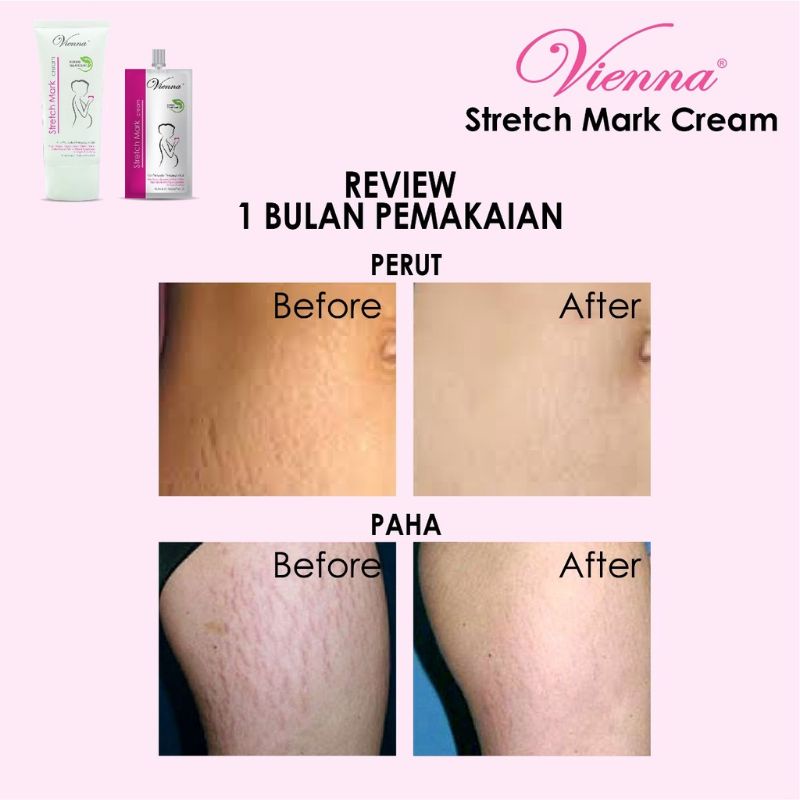 VIENNA STRETCH MARK CREAM BPOM