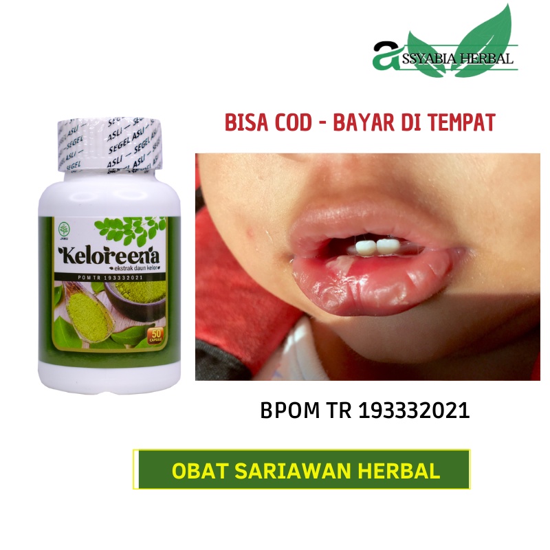 Obat Sariawan, Sariawan Mulut, Sariawan di Lidah, Sariawan Anak, Sariawan Cina, Sariawan Bubuk Daun 