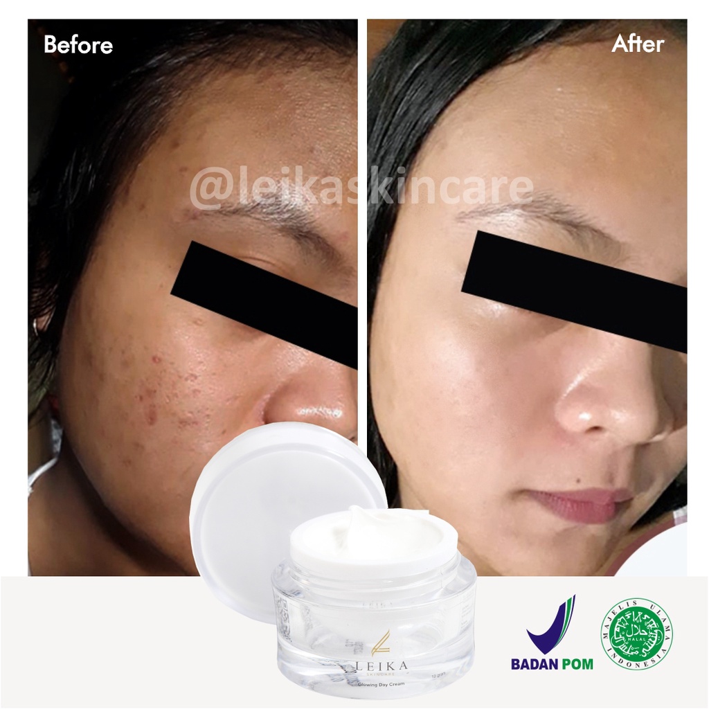 Krim Wajah Penghilang Bekas Luka Jerawat Asli 100% Ampuh! Penghilang Bekas Jerawat Bopeng Cepat BPOM Halal MUI Penghilang Bekas Jerawat Menghitam Glowing Day Cream Leika Skincare 10gr Original