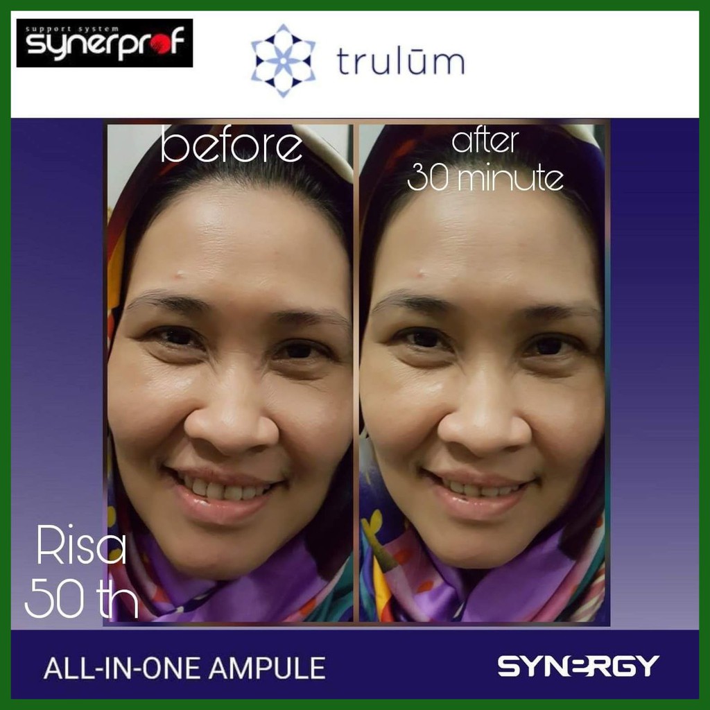 Hilangkan Bekas Jerawat Dengan Trulum | Trulum Instant Glowing