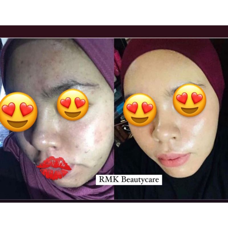 paket acne whitening cream jerawat radang jerawat bruntusan RMK