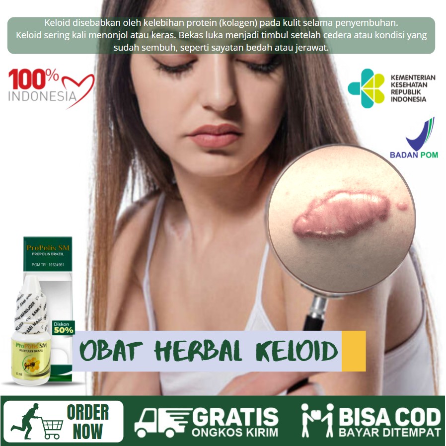 Obat Keloid, Pengempis Keloid, Obat Oles Keloid, Obat Keloid Bekas Caesar, Bekas Luka, Propolis SM
