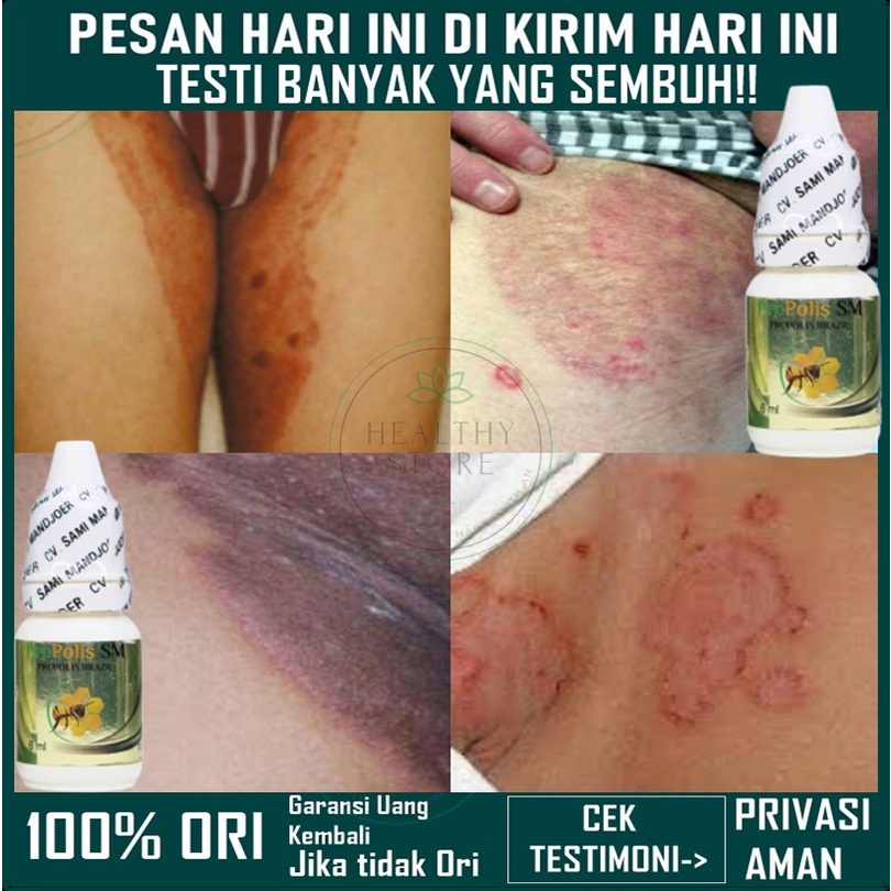 Obat Gatal Selangkangan, Obat Selangkangan hitam gatal, Obat Kurap Selangkangan, Salep gatal Selangkangan, Obat Gatel Selangkangan, Obat Selangkangan Eksim dan Jamur, Obat Jamur Selangkangan, Obat Selangkangan Hitam, Krim Selangkangan Hitam-1