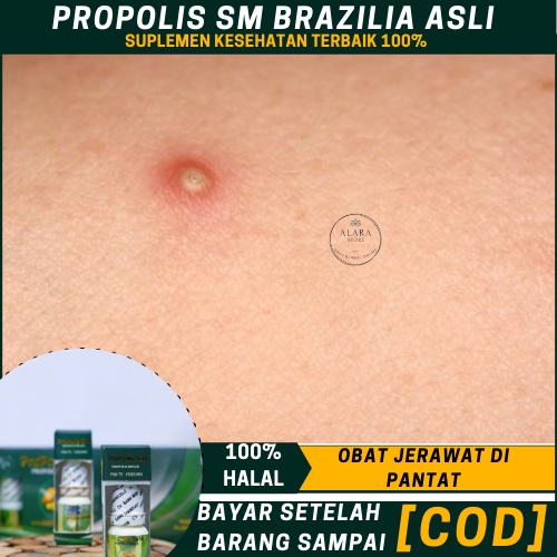 Obat Jerawat Di Pantat, Jerawat Di Bokong, Bruntusan Di Bokong, Menghilangkan   Bintik Bintik Di Bok