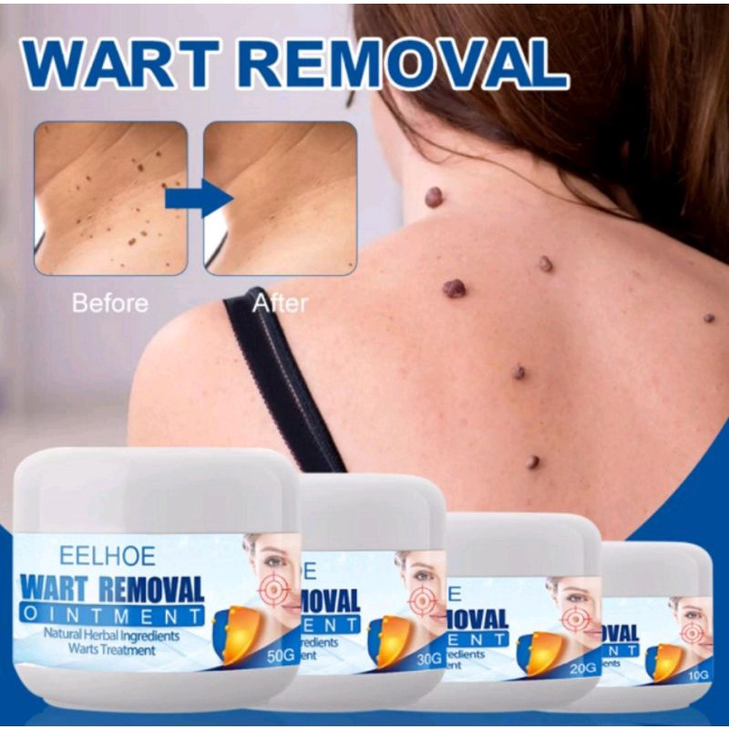 WART REMOVER OBAT KUTIL OBAT TAHI LALAT MATA IKAN