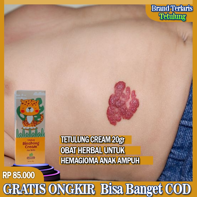 Obat Hemangioma, Tumor Hemangioma, Benjolan Kemerahan Pada Bayi, Penghilang Hemangioma, Bercak Mongo