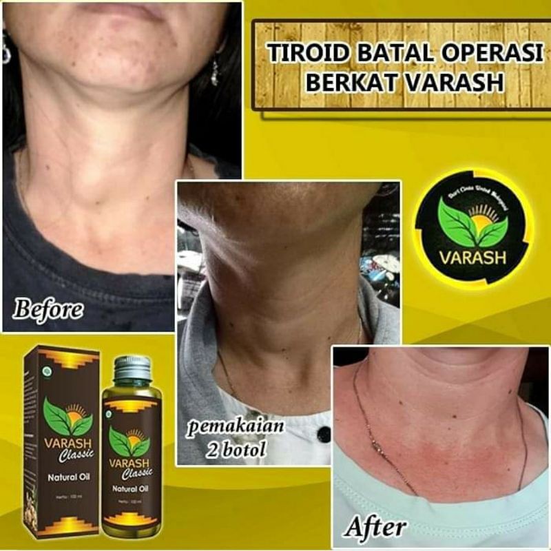 Jual Minyak Classic Untuk Lipoma Kista Syaraf Terjepit Promil Indonesia Shopee Indonesia