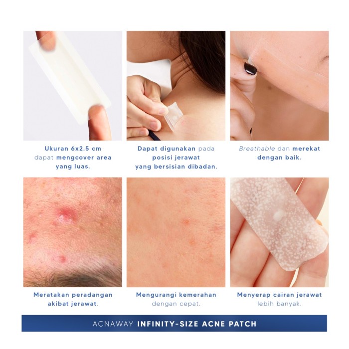 ACNAWAY Infinity Size Acne Patch / ACNAWAY Ultra Thin Acne Patch Day / ACNAWAY Patch / ACNAWAY Stubborn Acne Cream