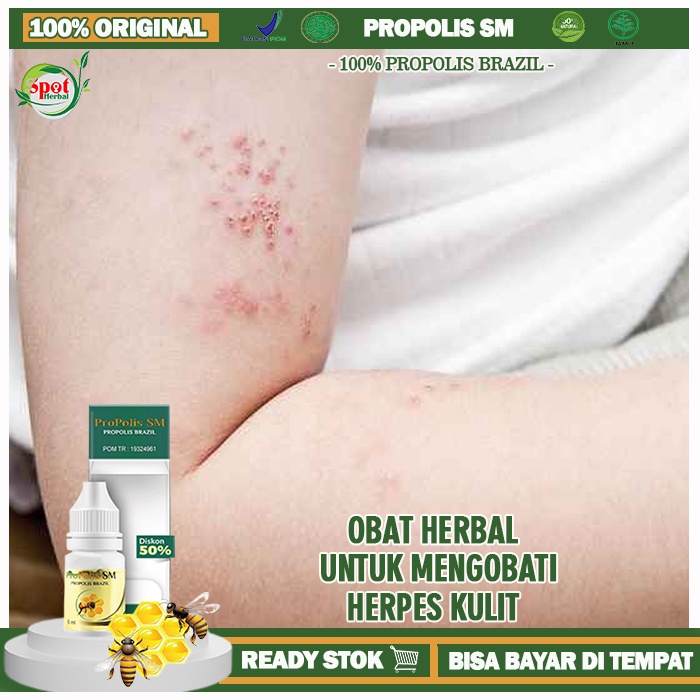 Obat Herpes Kulit,  Obat Herbal Herpes Kulit, Herpes Bibir Obat Kulit, Obat Herpes Genital, Obat Ole