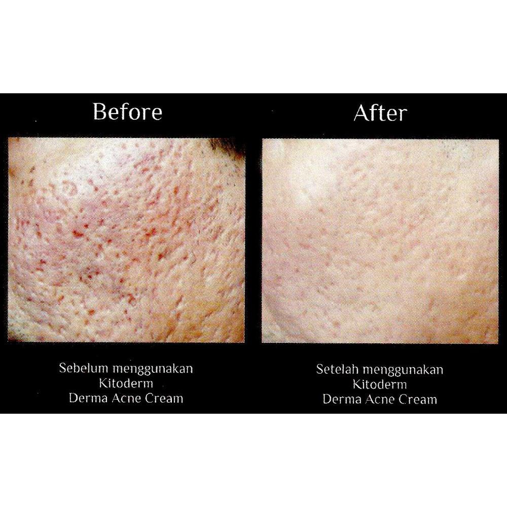 KITODERM DERMA ACNE CREAM | CREAM SCAR | CREAM BOPENG