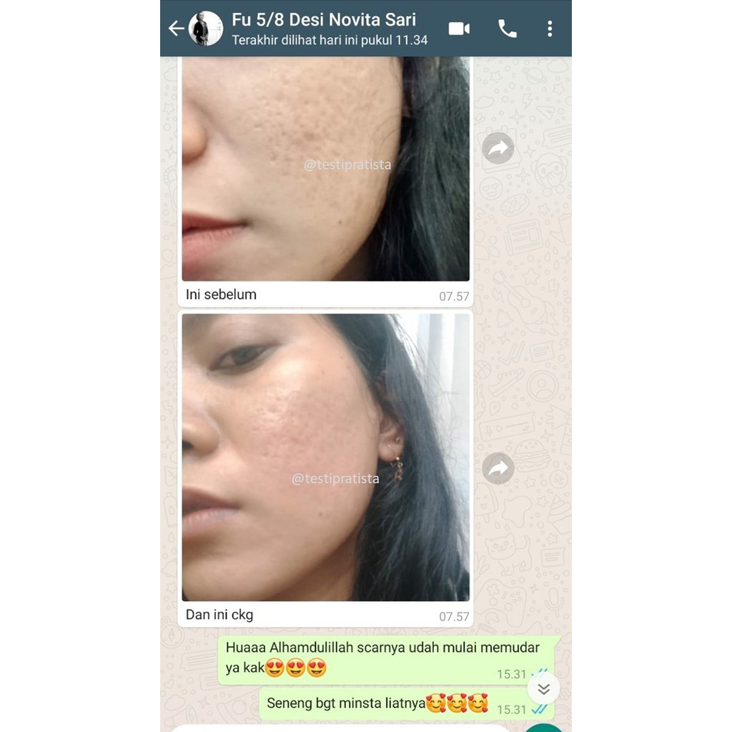 Cream Pratista Untuk Membantu Mengatasi Keluhan Kulit Bopeng Lubang Bekas Jerawat dan Cacar