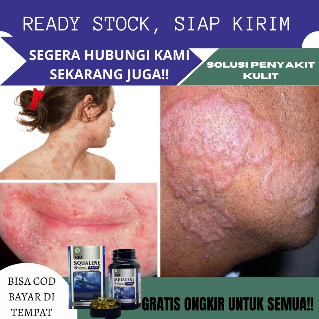 Obat Gatal Jamur Kulit Minum, Obat Gatal Jamur Selangkangan, Obat Jamur Kuku, Obat Jamur Kulit, Obat