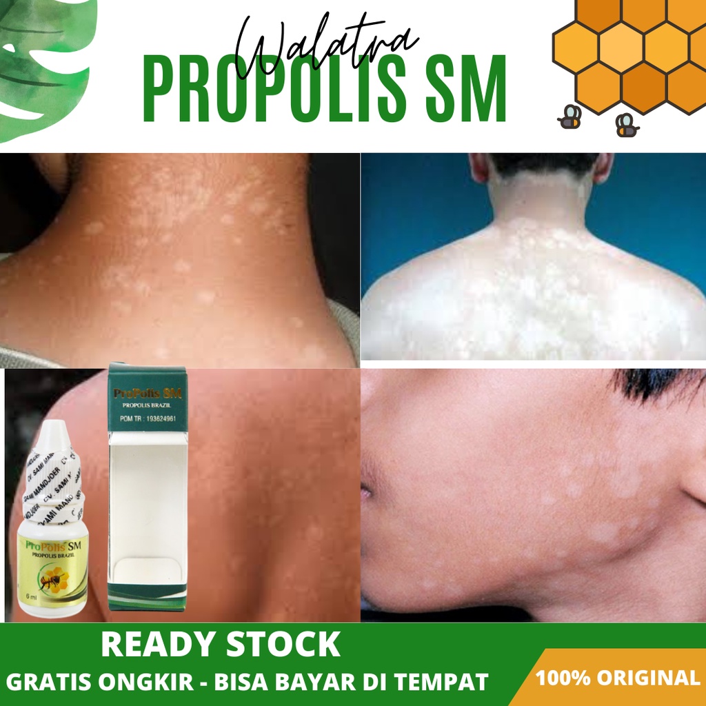 Obat Panu, Obat Penghilang Panu Di Wajah, Obat Panu Cair, Obat Kulit Panu, Obat Panu Untuk Anak, Oba