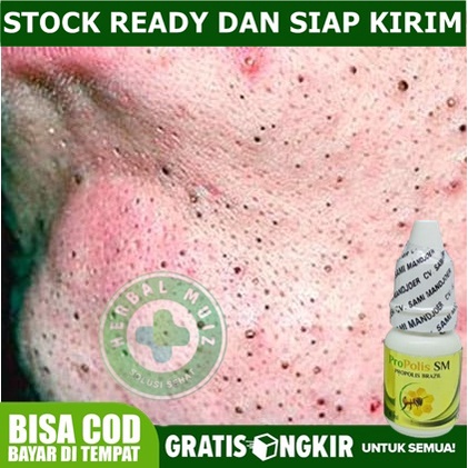 Obat Bersihkan Wajah dan Hidung dari Komedo Bintik Hitam Cocok Untuk ANAK / DEWASA - propolis sm
