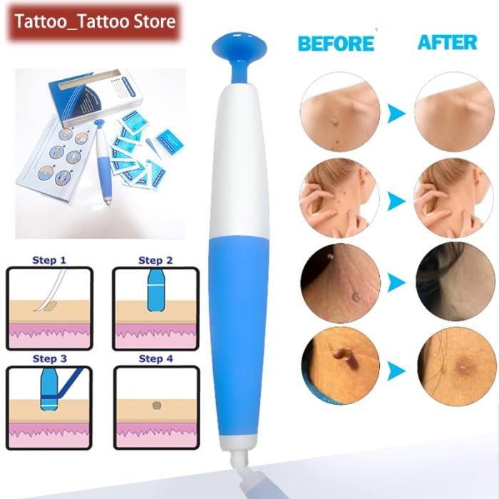 Alat Ukur | Nt Auto Band Skin Tag Remover Kits Face Skin Care Beauty Tools Wart R Kekinian Terlaris