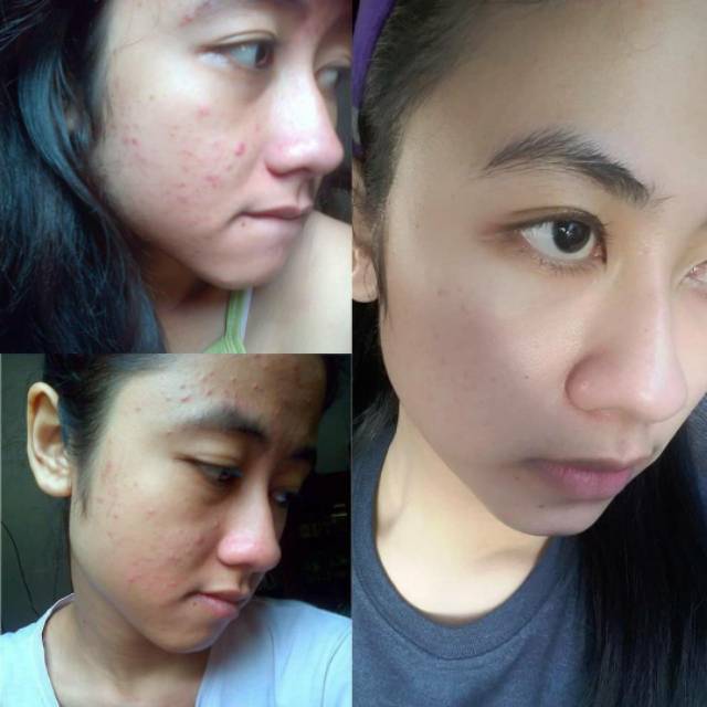 Ms Glow #Free Gift Acne Series Original Barcode Msglow Original - Paket Acne Basic (Paket Jerawat)-4