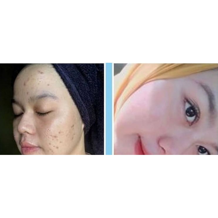 SKINCARE WAJAH GLOWING THERASKIN ACNE GLOW CREAM GLOWING PENCERAH WAJAH TONER WAJAH FACIAL WASH CREAM WAJAH GLOWING BPOM PAKET GLOWING PERAWATAN WAJAH