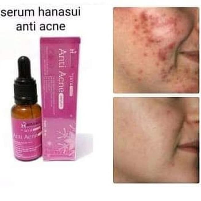 Hanasui Serum Anti Acne Menghilangkan Jerawat Aman Ampuh Asli Shopee Indonesia