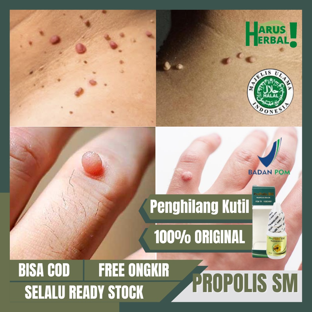 Obat Herbal Penghilang Kutil, Obat Kutil Papiloma, Obat Perontok Kutil, Obat Kutil Di Jari, Kutil Di