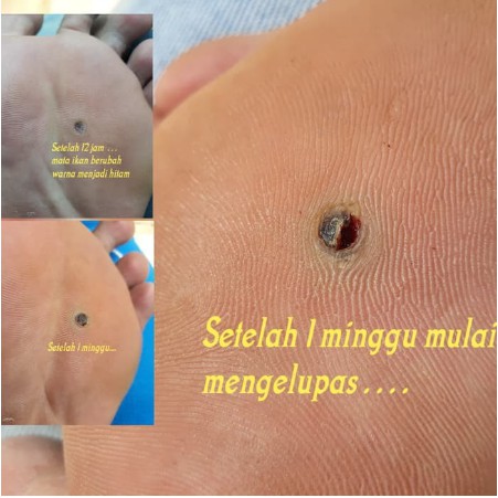 Obat penyakit mata ikan atau clavus bukan plester salep callusol