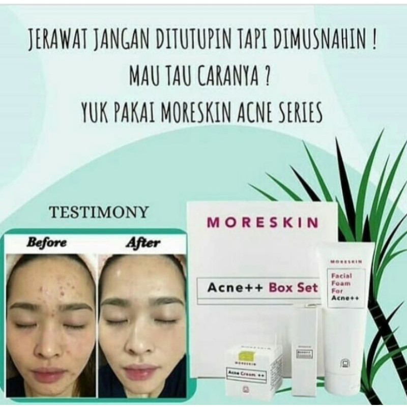 Moreskin anti acne ++ Box set, BPOM lebih murah harga Box set