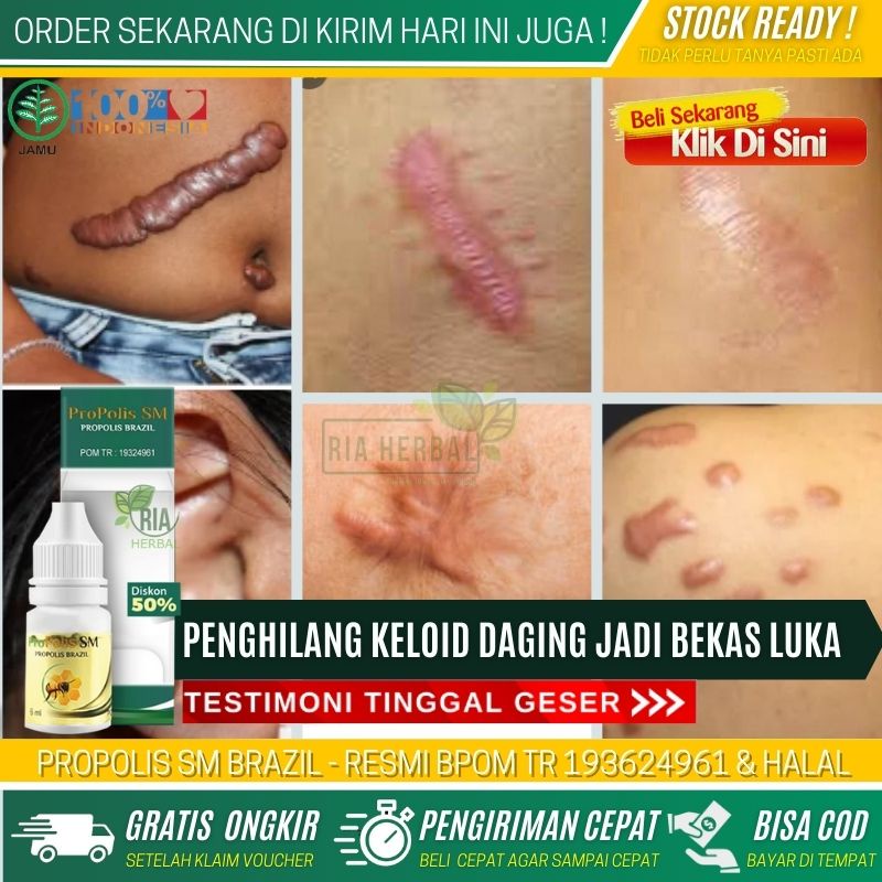 Obat Untuk Menghilangkan Keloid Yang Sudah Lama, Obat Penghilang Keloid, Obat Perontok Daging Jadi, 