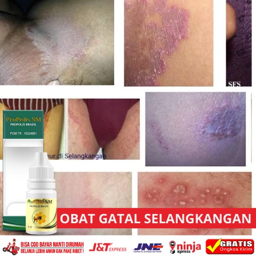 Obat Gatal Selangkangan Pria - Penghilang Gatal Selangkanga Pria, Salep Gatal Selangkangan Pria