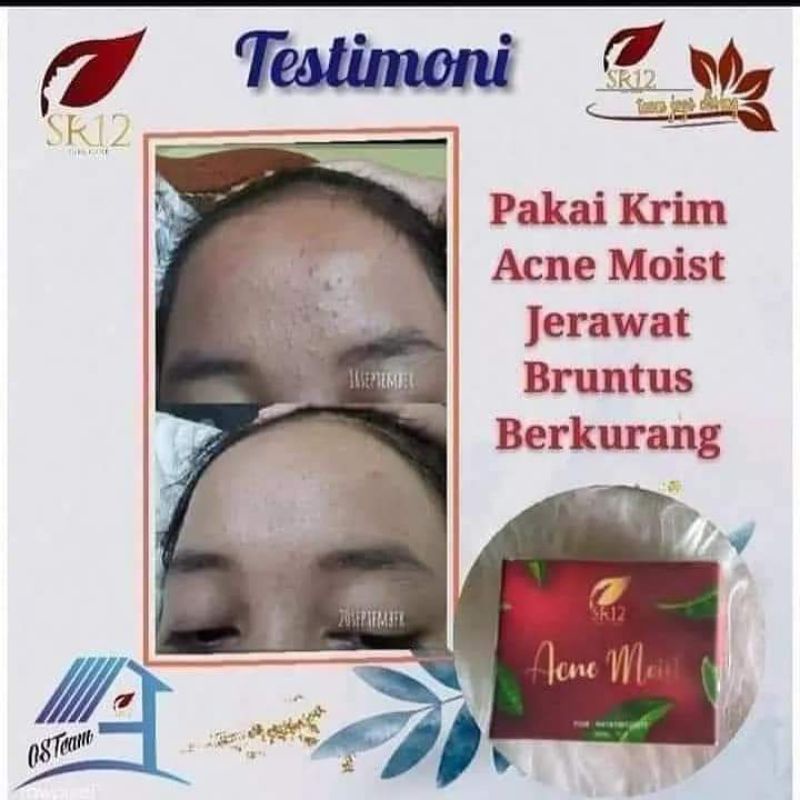 ACNE MOIST SR12 / ATASI JERAWAT