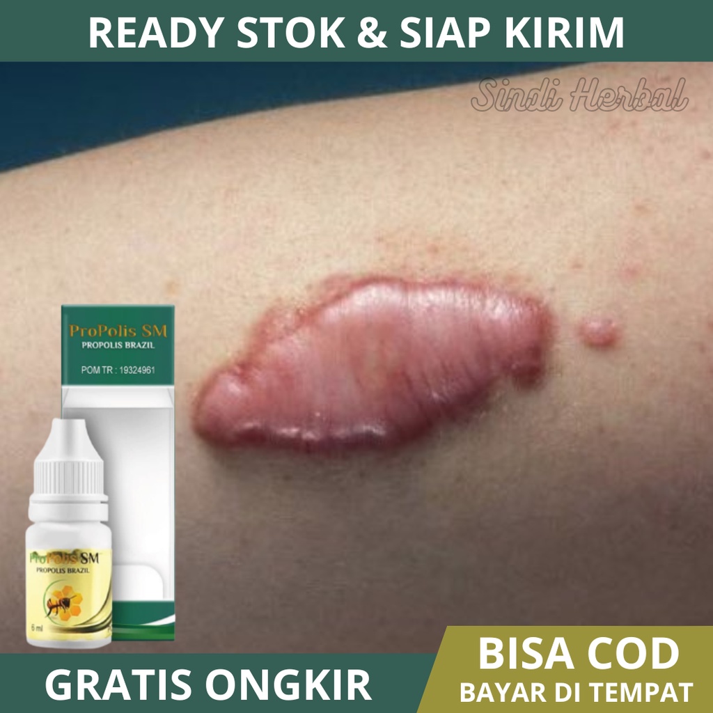 Obat Keloid - Obat Keloid Daging Tumbuh - Obat Daging Jadi - Obat Penghilang Keloid - Obat Untuk Men