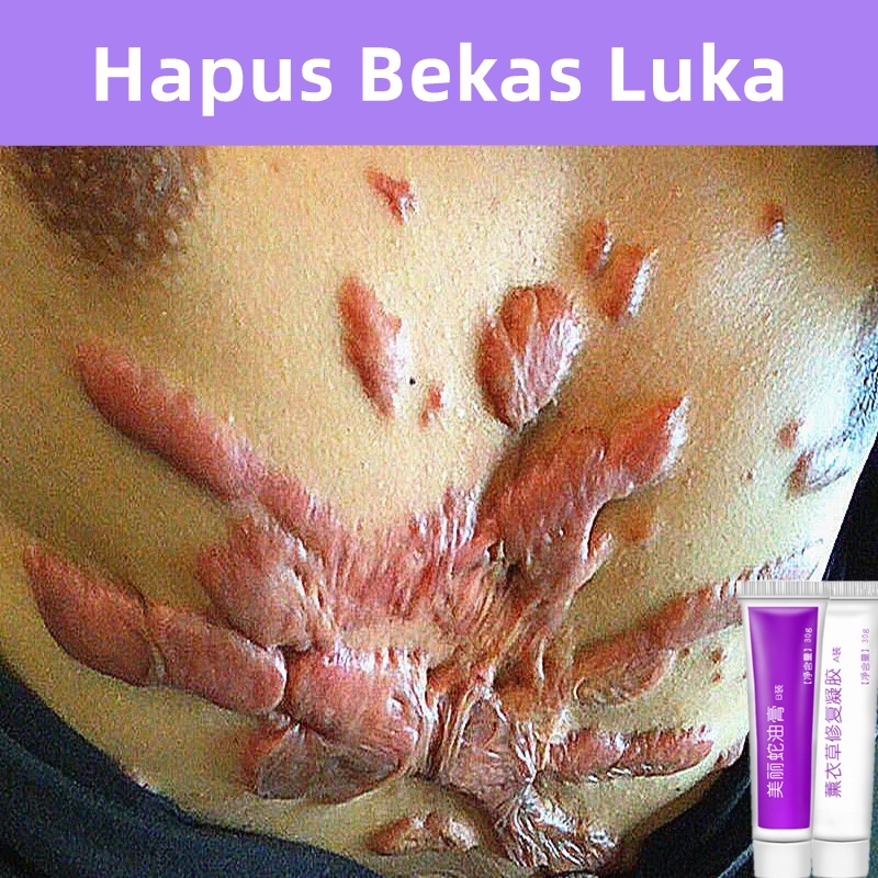 Gel Bekas Luka Krim Bekas Luka 30gr Penghapusan Bekas Luka Jerawat Membakar Stretch Mark Scab Krim Penghilang Bekas Luka Minyak Ular