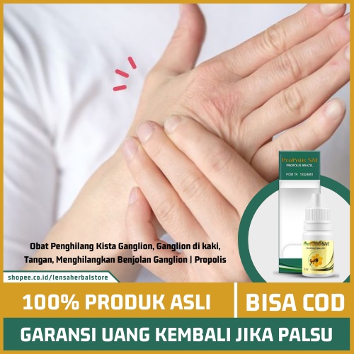 Obat Oles Ganglion di Apotik, Obat Benjolan di Pergelangan Tangan, Salep Untuk Ganglion, Obat Kista 