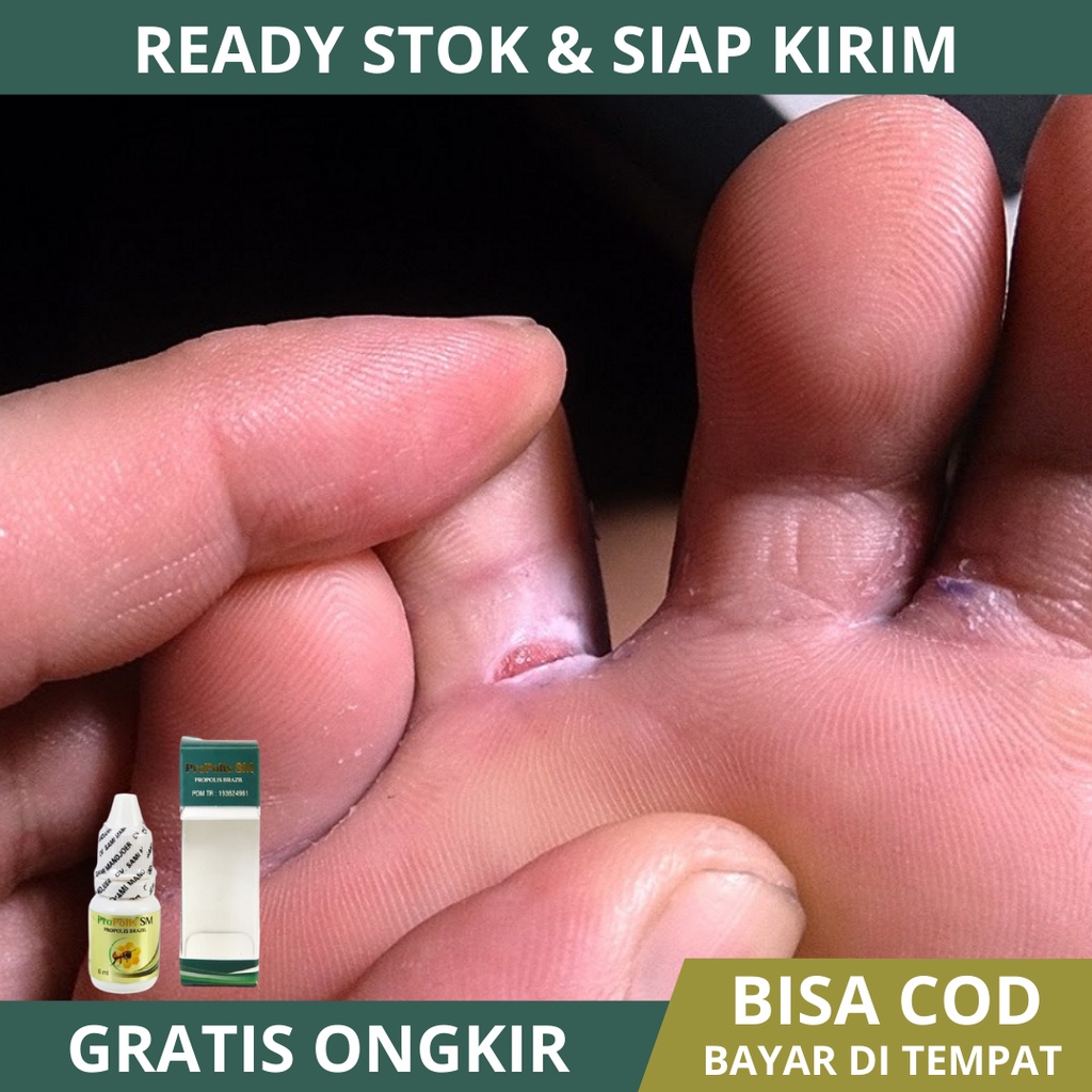 Obat Kutu Air Pada Sela Jari Kaki, Obat Kutu Air Parah, Obat Rangen Parah, Kutu Air Basah, Kutu Air 