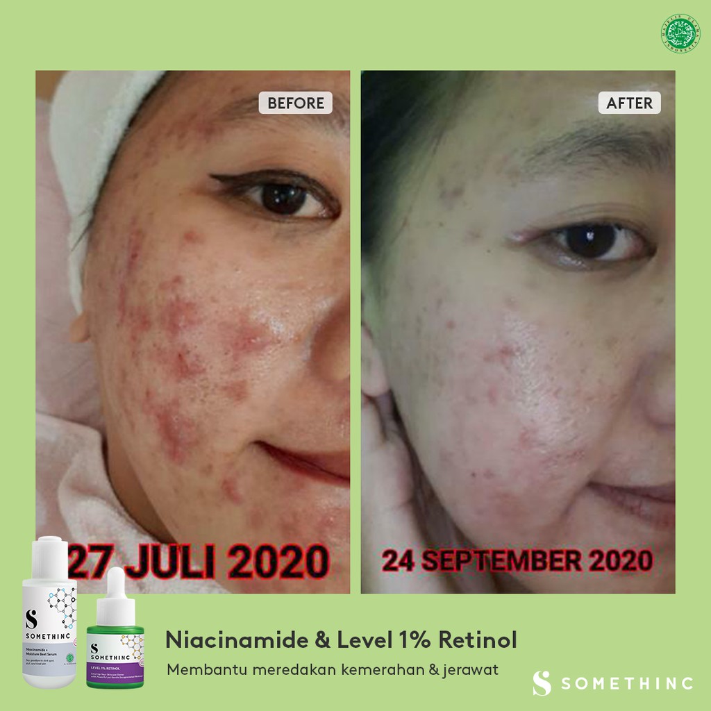 Somethinc Level 1% Retinol Penghilang Jerawat Komedo Kerutan Bruntusan Bekas Luka Wajah