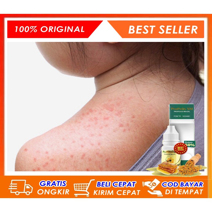 Obat Biang Keringat, Penghilang Ruam Gatal Biang Keringat Untuk Anak dan Dewasa Tanpa Efek Samping