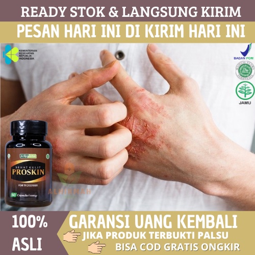 Obat Eksim, Obat Eksim Kering, Obat Eksim Kering Menahun, Obat Eksim Basah, Obat Gatal Eksim, Obat K