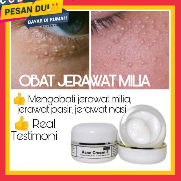 Syringoma Cream Penghilang Milia Bintik Putih dan Jerawat Pasir Ampuh