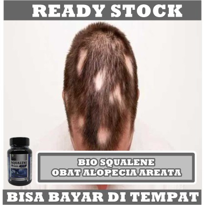 Obat Alopecia Areata - Kebotakan Rambut Pada kepala - Penyakit Autoimun - Penumbuh Rambut Botak - Pencegah Rambut Rontok, - Mengobati Kebotakan - Penumbuh Rambut Rontok - Penumbuh Rambut Kepala 100% Alami