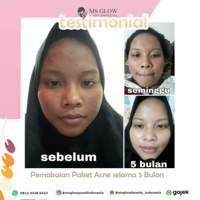 Ms Glow #Free Gift Acne Series Original Barcode Msglow Original - Paket Acne Basic (Paket Jerawat)-5