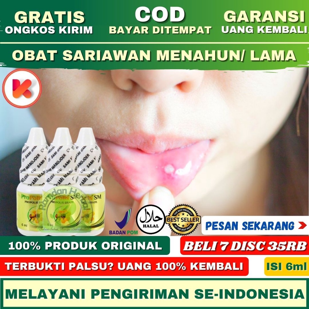 OBAT SARIAWAN Obat Sariawan Menahun Obat Sariawan Sudah Lama Obat Sariawan Sering Kambuh Propolis SM