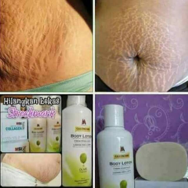 Penghilang Strechmark Lotion Glutacare Msi Shopee Indonesia