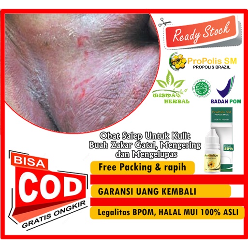 Obat Salep Untuk Kulit Buah Zakar Gatal, Mengering dan Mengelupas | Herbal Menghilangkan Kudis atau 